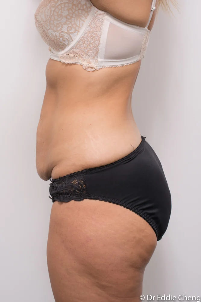 Before and after tummy tuck by Dr Eddie Cheng, Brisbane