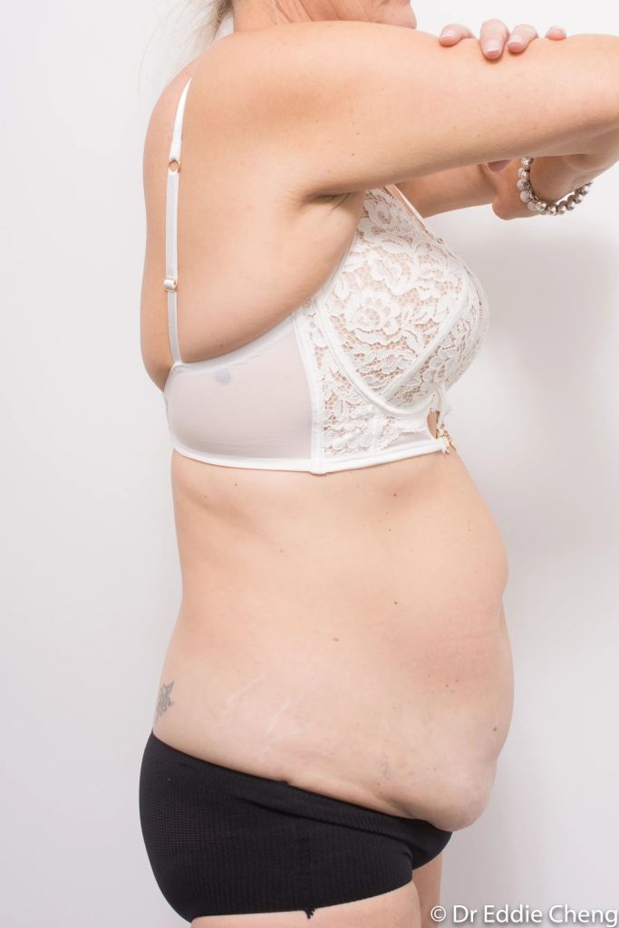 Before and after tummy tuck by Dr Eddie Cheng, Brisbane