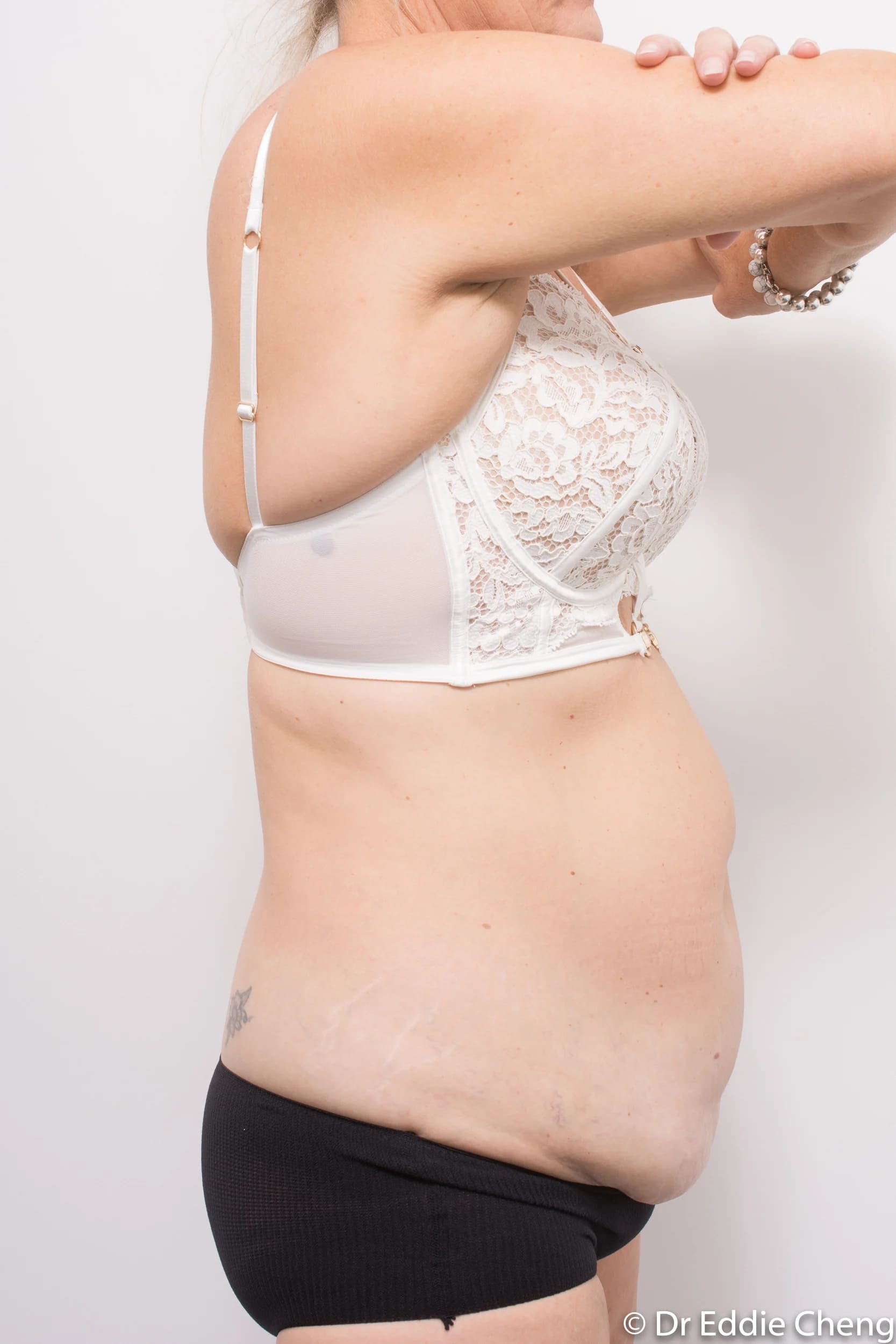 Before and after tummy tuck by Dr Eddie Cheng, Brisbane