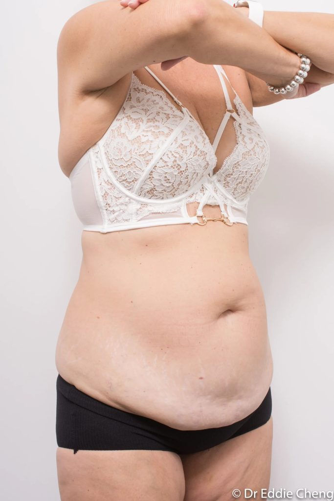 Before and after tummy tuck by Dr Eddie Cheng, Brisbane