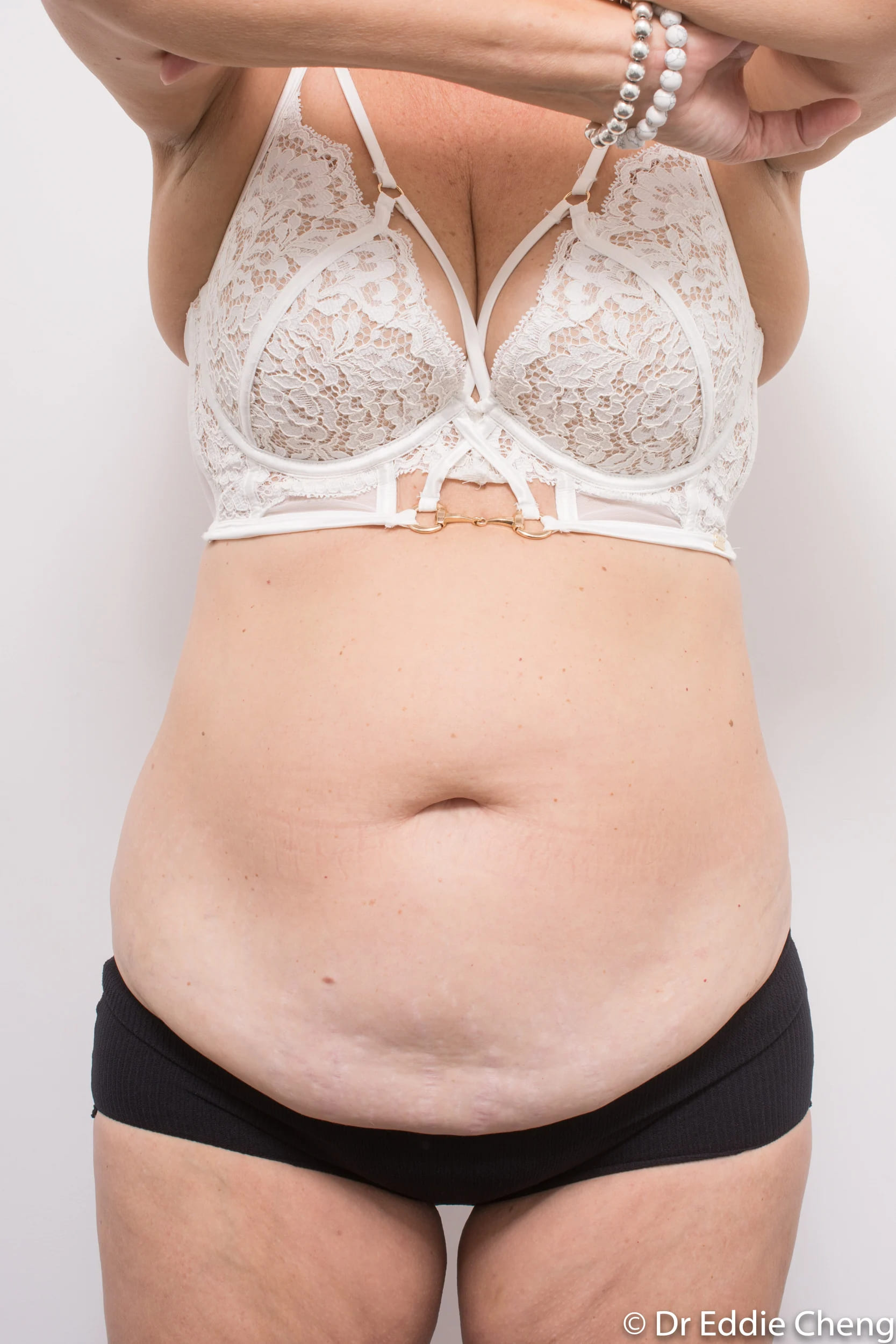 Before and after tummy tuck by Dr Eddie Cheng, Brisbane