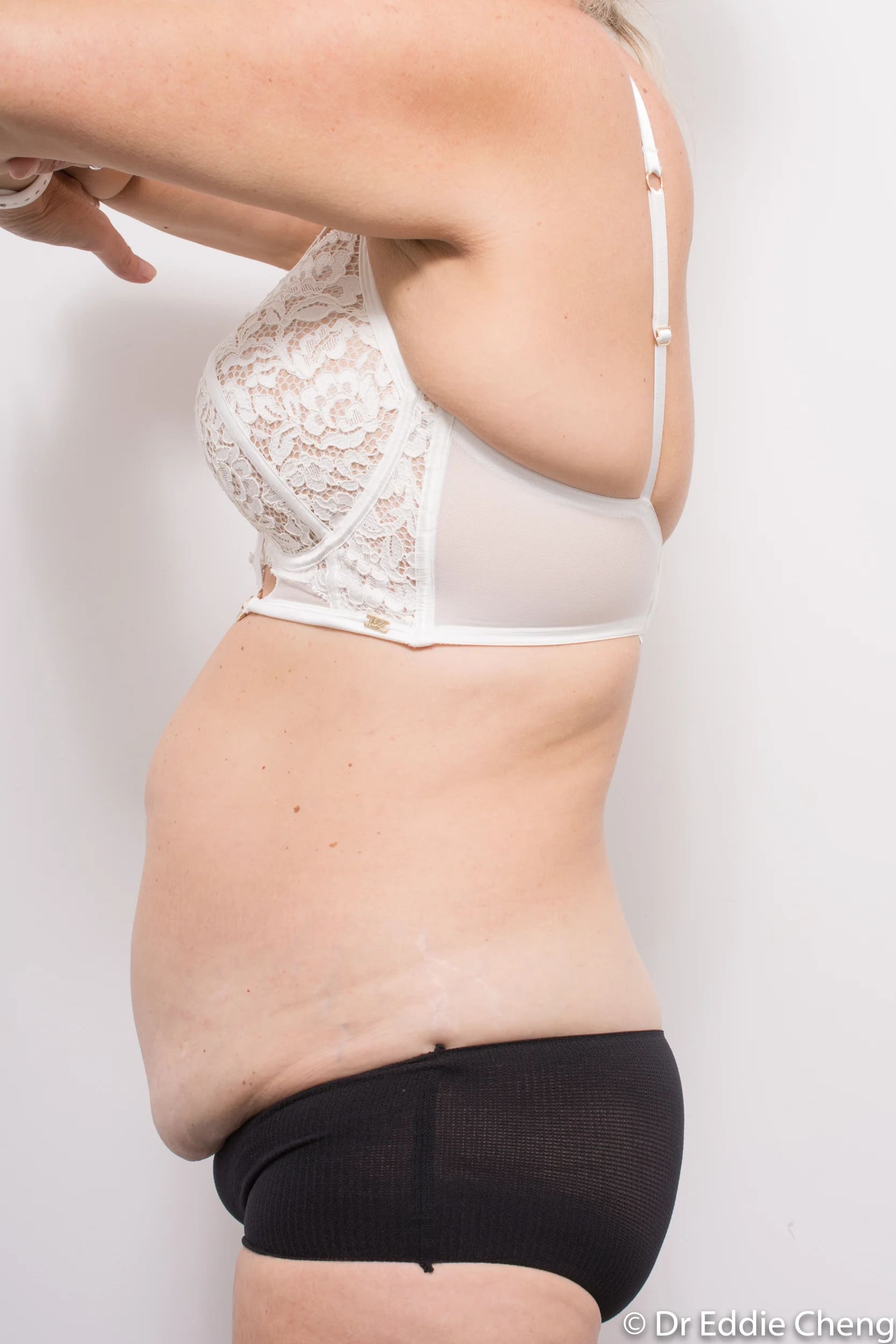 Before and after tummy tuck by Dr Eddie Cheng, Brisbane