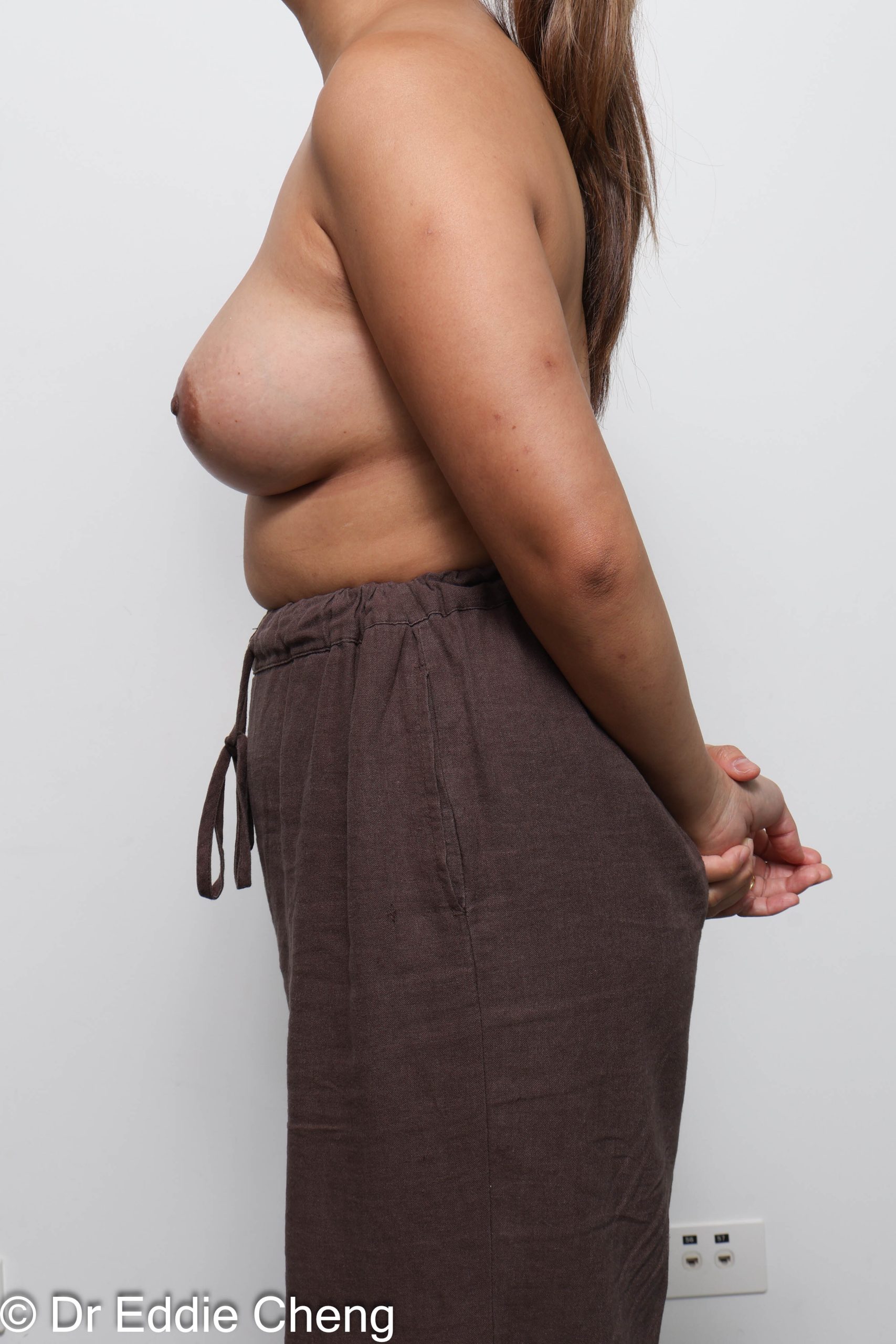 Before and after breast augmentation surgery by Dr Eddie Cheng, Brisbane