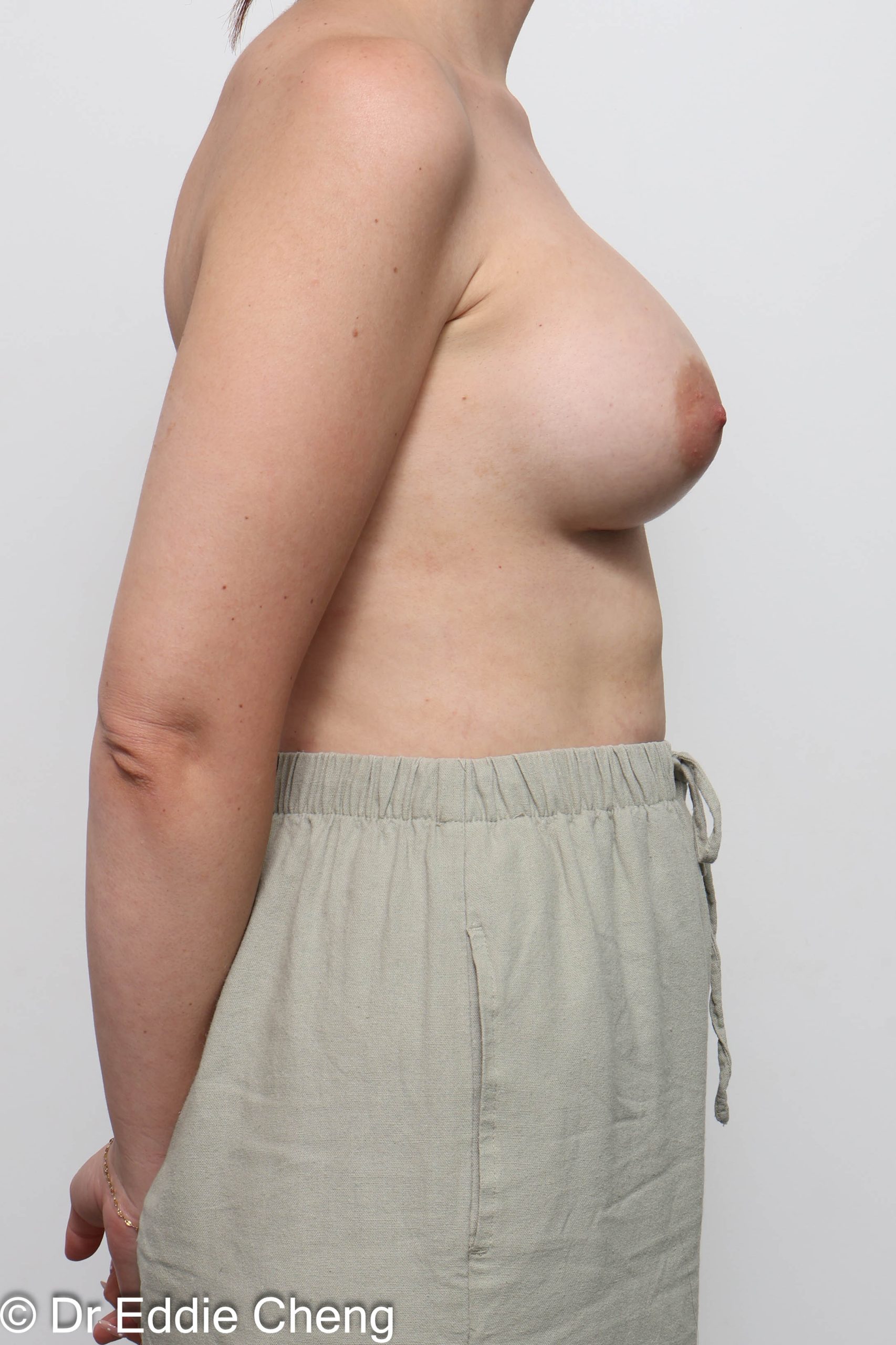 Before and after breast augmentation surgery by Dr Eddie Cheng, AR Plastic Surgery Brisbane